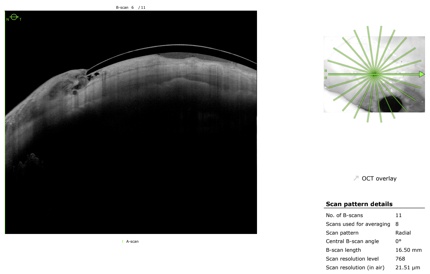 Claps Optical Scan Looking Deeper for Success: OCT in Complex Scleral Lens Fitting ...